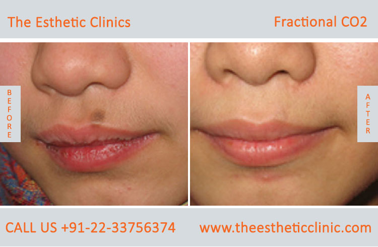 Fractional Co2 Laser Skin Resurfacing Treatment before after photos in mumbai india (5)